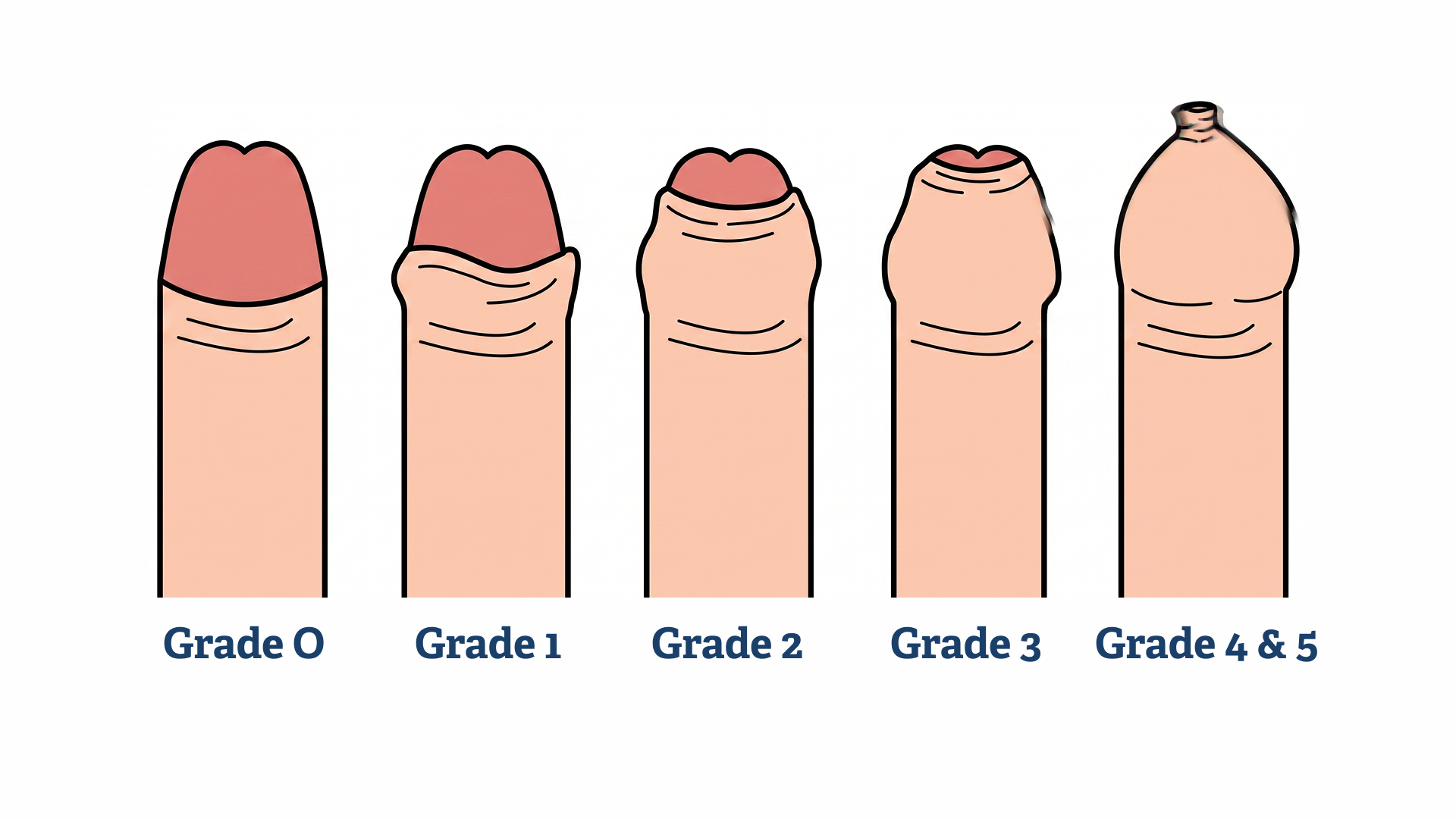 Illustration of five penises, each showing different grades of phimosis from Grade 0 (fully retractable foreskin) to Grades 4 & 5 (tight foreskin that cannot be retracted), labelled accordingly below each image.