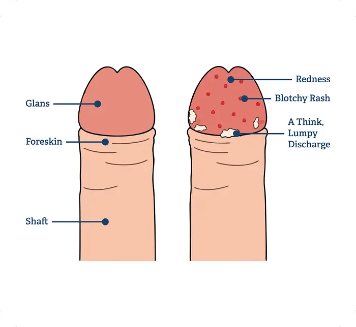 Illustration comparing a healthy penis with one showing thrush, with redness, a blotchy rash and thick white discharge under the foreskin.